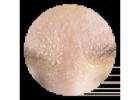 Dry Skin Treatment | Results Laser Online