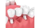 Phye Family Dentistry – Dental Bridges in Olathe for Restored Smiles