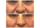 Jawline Filler Treatments in West Loop Chicago - Opulence Chicago LLC