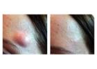 Before and After Lipoma Removal – Safe Treatment Results