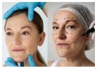 Find Best Option for Face Lift in Adelaide for Long Lasting Results