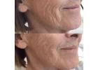 Envy Aesthetics: Skin Boosters Injections for Radiant & Youthful Skin