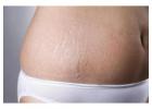 stretch mark removal