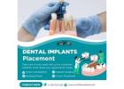 How Safe Is Dental Implants Placement?