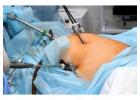 Laparoscopic Surgery Near Me – Advanced & Painless Procedures