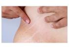 Stretch Mark Removal Treatment