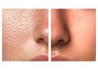 open pores on face