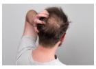 Hair Loss Treatment for men