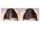 Exosome Therapy for Hair