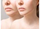 What’s the Difference Between a Lip Lift and a Mini Facelift?