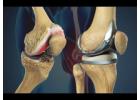 Consult the Best Knee Replacement Surgeon in Vaishali Nagar – Dr. Arvind Asopa