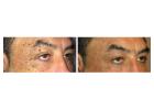 Eye Skin Tag Removal – Gentle and Expert Care at London Dermatology Clinics