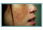 Face Skin Tag Removal – Safe and Gentle Care at London Dermatology Clinics