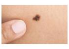 Mole Check