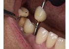 Find top-notch surgeons and dental equipment for Wisdom teeth removal Tijuana