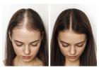 Hair Loss Solutions Dallas | Women’s Thinning Hair Specialist