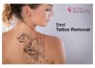 Best Laser Tattoo Removal in Bangalore - Guaranteed Results