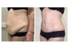 Royal Cosmetic Surgery – Expert Liposuction & Cosmetic Treatments in Islamabad