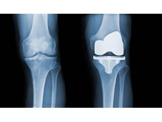 Knee Replacement Surgery | Maddagar Foundation Knee Replacement Surgery | Maddagar Foundation