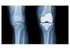 Knee Replacement Surgery | Maddagar Foundation