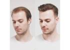 FUT Hair Transplant in Islamabad