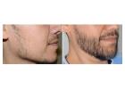 Beard Hair Transplant in Islamabad