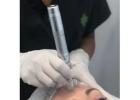 Facial Hair Removal | Results Laser Clinic