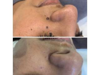 Skin tag removal clinic Goodmayes Skin tag removal clinic Goodmayes