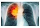Lung Cancer Romsey