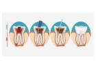 Best Root Canal Treatment in India
