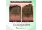 Reclaim Confidence with Natural Solutions for Thinning Hair