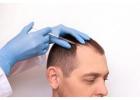 Exosome Therapy for Hair