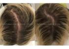 Practical Solutions for Female Hair Loss in Melbourne