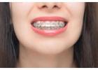 Invisible & Ceramic Braces at Vyom Dental Clinic, Ahmedabad