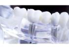 Affordable Dental Implants – Restore Your Smile Today!