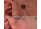 Laser removal of skin tag