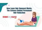 How Laser Hair Removal Works – The Science Behind Permanent Hair Reduction