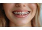 Affordable Braces Singapore – Achieve Your Perfect Smile