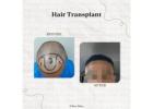 Dr Ditta Hair Transplants- Expert Hair Transplant for Women in Manchester