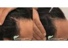 Unlock the Power of Science-Backed Hair Loss Treatment