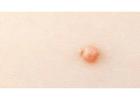 Genital Warts Removal London – Discreet Care at London Dermatology Clinics