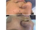 Skin tag removal clinic Goodmayes