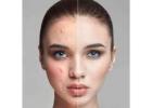 Pimple Scar Treatment
