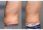 Liposuction for Body Shaping and Toning in Islamabad