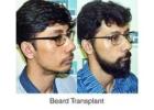 Dr Ditta Hair Transplants Performs Expert Beard Transplants in Manchester