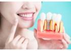 Dental Implants in Buckhead