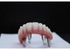 Find Trustworthy Teeth Replacements with Tijuana Dental Implants