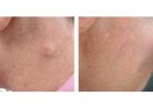 Cyst Removal Harley Street – Expert Treatment at London Dermatology Clinics