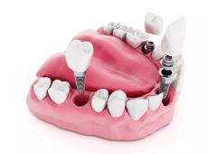 Dental Implants in Islamabad – How They Integrate with the Jawbone Dental Implants in Islamabad – How They Integrate with the Jawbone