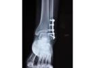 Expert Orthopaedic Care & Joint Replacement by Leading Orthopaedic Doctors in Indore